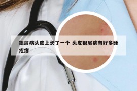 銀屑病頭皮上長(zhǎng)了一個(gè) 頭皮銀屑病有好多硬疙瘩