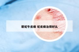 蘄蛇牛皮癬 蛇皮癬治得好么