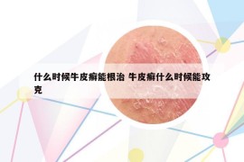什么時候牛皮癬能根治 牛皮癬什么時候能攻克