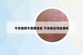 牛皮癬需不需要戒色 牛皮癬必須戒酒嗎