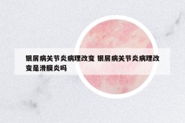 銀屑病關(guān)節(jié)炎病理改變 銀屑病關(guān)節(jié)炎病理改變是滑膜炎嗎