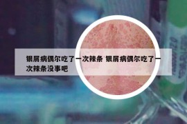 銀屑病偶爾吃了一次辣條 銀屑病偶爾吃了一次辣條沒(méi)事吧