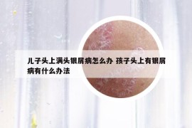 兒子頭上滿頭銀屑病怎么辦 孩子頭上有銀屑病有什么辦法