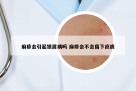 麻疹會引起銀屑病嗎 麻疹會不會留下疤痕