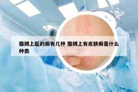 胳膊上起的癬有幾種 胳膊上有皮膚癬是什么種類