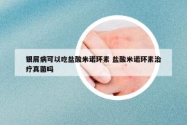 銀屑病可以吃鹽酸米諾環(huán)素 鹽酸米諾環(huán)素治療真菌嗎