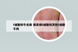 t細(xì)胞和牛皮癬 銀屑病t細(xì)胞和其他t細(xì)胞不同