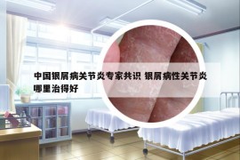 中國(guó)銀屑病關(guān)節(jié)炎專家共識(shí) 銀屑病性關(guān)節(jié)炎哪里治得好