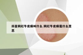 抖音網紅牛皮癬叫什么 網紅牛皮癬是什么意思