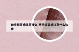 秋季銀屑病注意什么 秋季銀屑病注意什么飲食