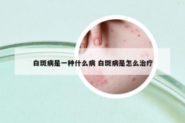 白斑病是一種什么病 白斑病是怎么治療