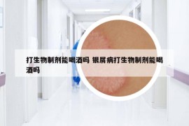 打生物制劑能喝酒嗎 銀屑病打生物制劑能喝酒嗎