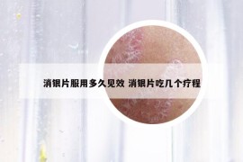 消銀片服用多久見效 消銀片吃幾個(gè)療程