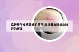 臨沂看牛皮癬最好的醫(yī)院 臨沂看皮膚病比較好的醫(yī)生