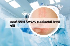 銀屑病我要注意什么呢 銀屑病應該注意哪些方面