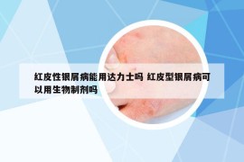 紅皮性銀屑病能用達(dá)力士嗎 紅皮型銀屑病可以用生物制劑嗎