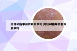腳趾和指甲會有銀屑病嗎 腳趾和指甲會有銀屑病嗎