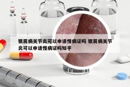 銀屑病關(guān)節(jié)炎可以申請(qǐng)慢病證嗎 銀屑病關(guān)節(jié)炎可以申請(qǐng)慢病證嗎知乎