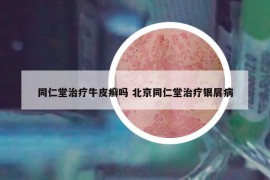 同仁堂治療牛皮癬嗎 北京同仁堂治療銀屑病