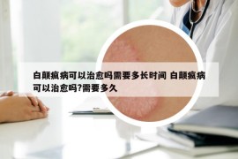 白顛瘋病可以治愈嗎需要多長時間 白顛瘋病可以治愈嗎?需要多久