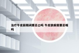 治療牛皮蘚期間要忌口嗎 牛皮膚癬需要忌嘴嗎