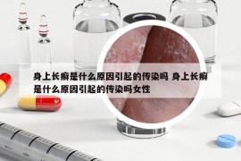 身上長癬是什么原因引起的傳染嗎 身上長癬是什么原因引起的傳染嗎女性