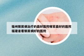 福州銀屑病治療的最好醫(yī)院哪家最好的醫(yī)院 福建省看銀屑病好的醫(yī)院
