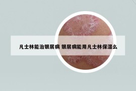 凡士林能治銀屑病 銀屑病能用凡士林保濕么
