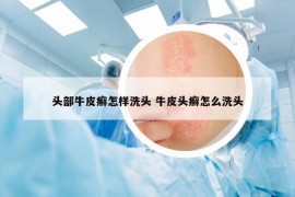 頭部牛皮癬怎樣洗頭 牛皮頭癬怎么洗頭