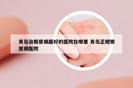 青島治銀屑病最好的醫(yī)院在哪里 青島正規(guī)銀屑病醫(yī)院