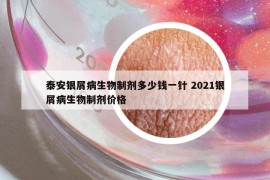 泰安銀屑病生物制劑多少錢一針 2021銀屑病生物制劑價(jià)格