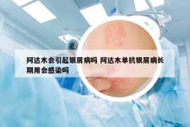 阿達(dá)木會(huì)引起銀屑病嗎 阿達(dá)木單抗銀屑病長(zhǎng)期用會(huì)感染嗎