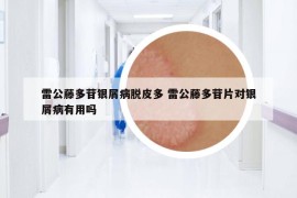 雷公藤多苷銀屑病脫皮多 雷公藤多苷片對(duì)銀屑病有用嗎