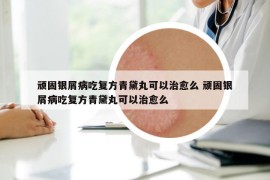 頑固銀屑病吃復(fù)方青黛丸可以治愈么 頑固銀屑病吃復(fù)方青黛丸可以治愈么