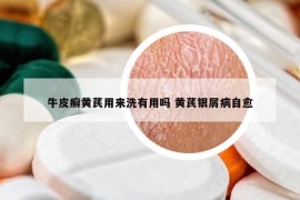牛皮癬黃芪用來洗有用嗎 黃芪銀屑病自愈