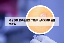哈爾濱銀屑病在哪治療最好 哈爾濱銀屑病醫(yī)院排名