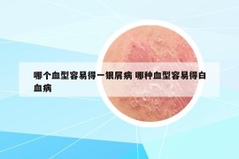 哪個(gè)血型容易得一銀屑病 哪種血型容易得白血病