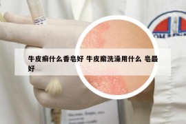 牛皮癬什么香皂好 牛皮廨洗澡用什么 皂最好