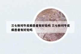 三七粉對牛皮癬患者有好處嗎 三七粉對牛皮癬患者有好處嗎