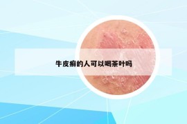 牛皮癬的人可以喝茶葉嗎