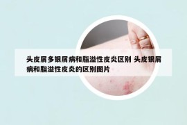 頭皮屑多銀屑病和脂溢性皮炎區(qū)別 頭皮銀屑病和脂溢性皮炎的區(qū)別圖片