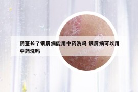 陰莖長(zhǎng)了銀屑病能用中藥洗嗎 銀屑病可以用中藥洗嗎