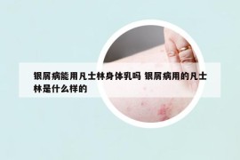 銀屑病能用凡士林身體乳嗎 銀屑病用的凡士林是什么樣的