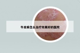 牛皮癬怎么治療效果好的醫(yī)院