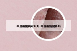 牛皮癬跳繩可以嗎 牛皮癬能健身嗎