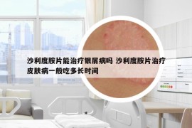 沙利度胺片能治療銀屑病嗎 沙利度胺片治療皮膚病一般吃多長時間