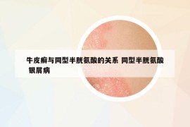 牛皮癬與同型半胱氨酸的關(guān)系 同型半胱氨酸 銀屑病