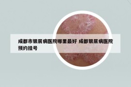 成都市銀屑病醫(yī)院哪里最好 成都銀屑病醫(yī)院預(yù)約掛號(hào)