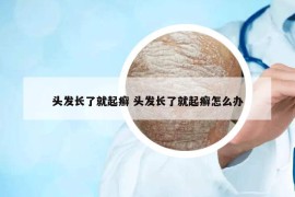 頭發(fā)長(zhǎng)了就起癬 頭發(fā)長(zhǎng)了就起癬怎么辦