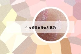 牛皮癬是有什么引起的